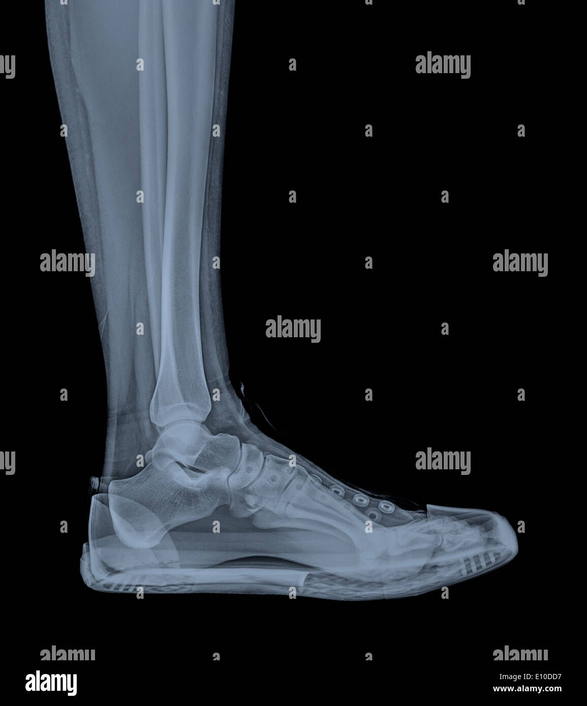 Raggi X di un piede e caviglia in un trainer Foto Stock