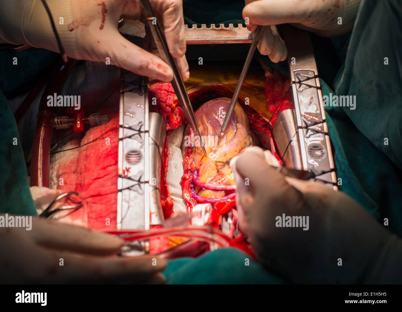 Innesto di bypass arterioso coronarico Foto Stock