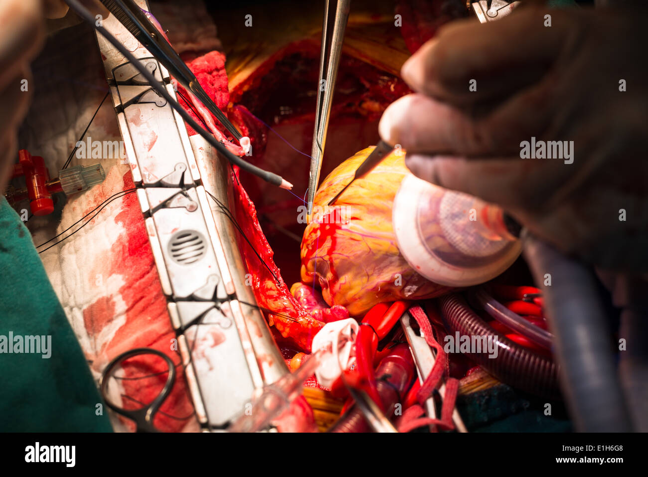 Innesto di bypass arterioso coronarico Foto Stock