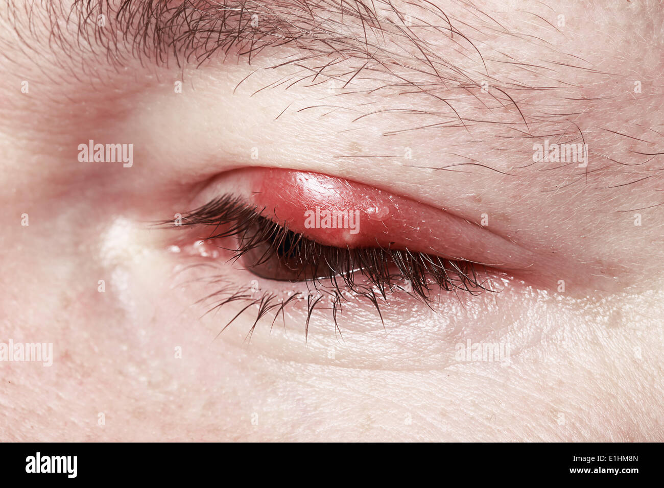 Mal di occhi rossi. Chalazion e blefarite. Infiammazione Foto Stock