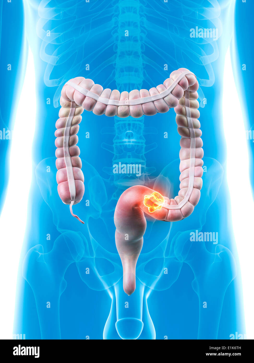 Uomo di grande intestino che mostra il cancro al colon computer grafica. Foto Stock