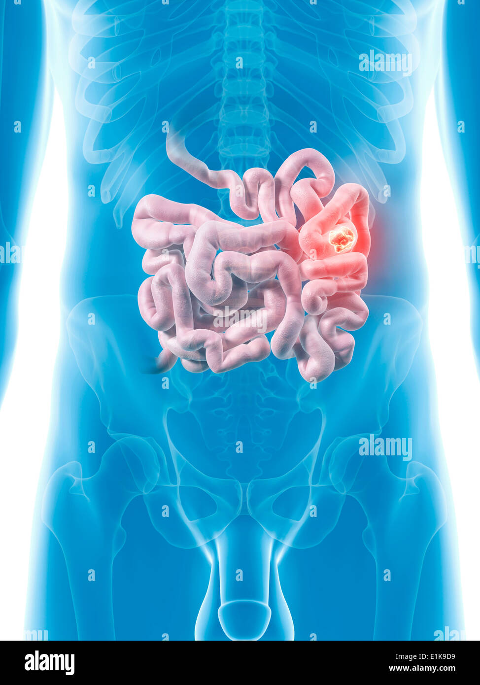 Intestino umano che mostra un tumore computer grafica. Foto Stock