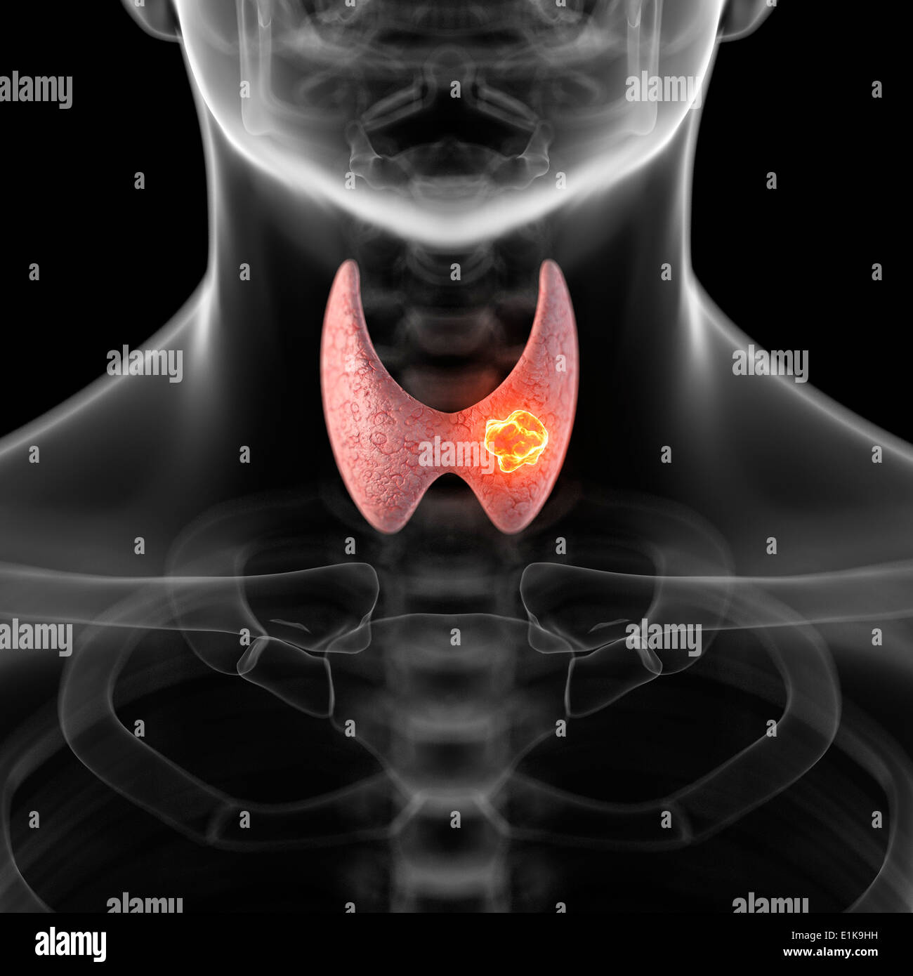 Umano ghiandola tiroide che mostra un tumore computer grafica. Foto Stock
