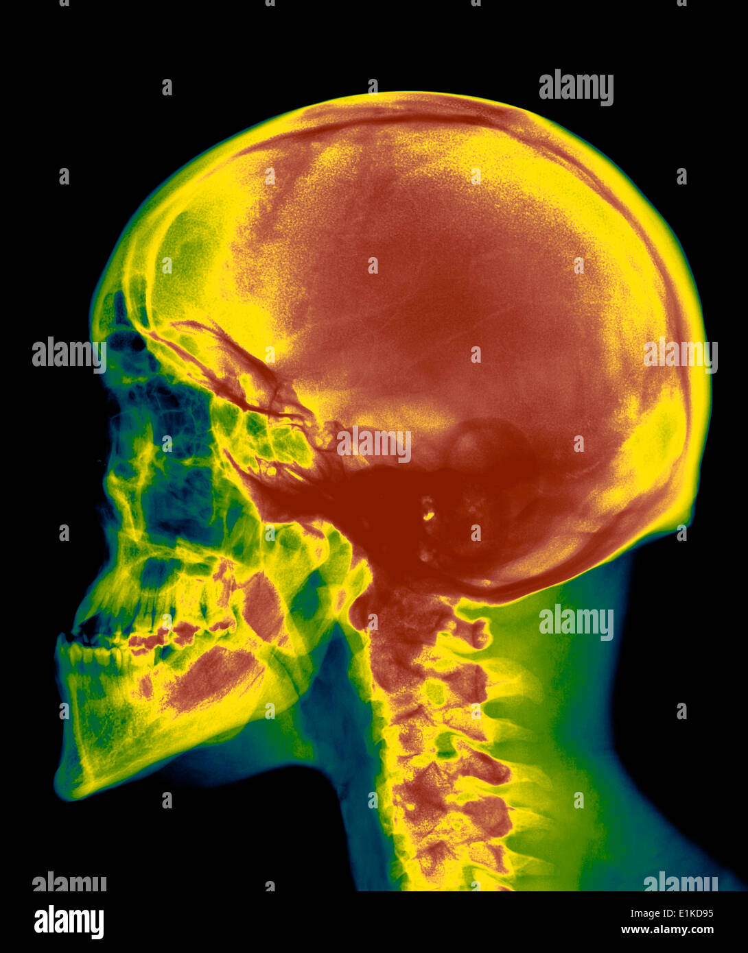Cranio colorato X-ray del cranio di un trentennale maschio. Foto Stock