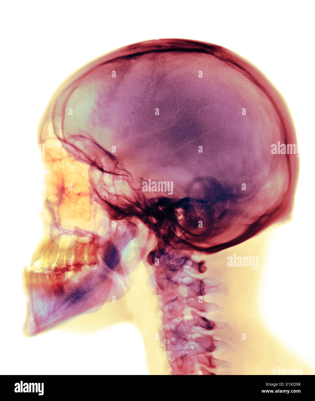 Cranio colorato X-ray del cranio di un trentennale maschio. Foto Stock