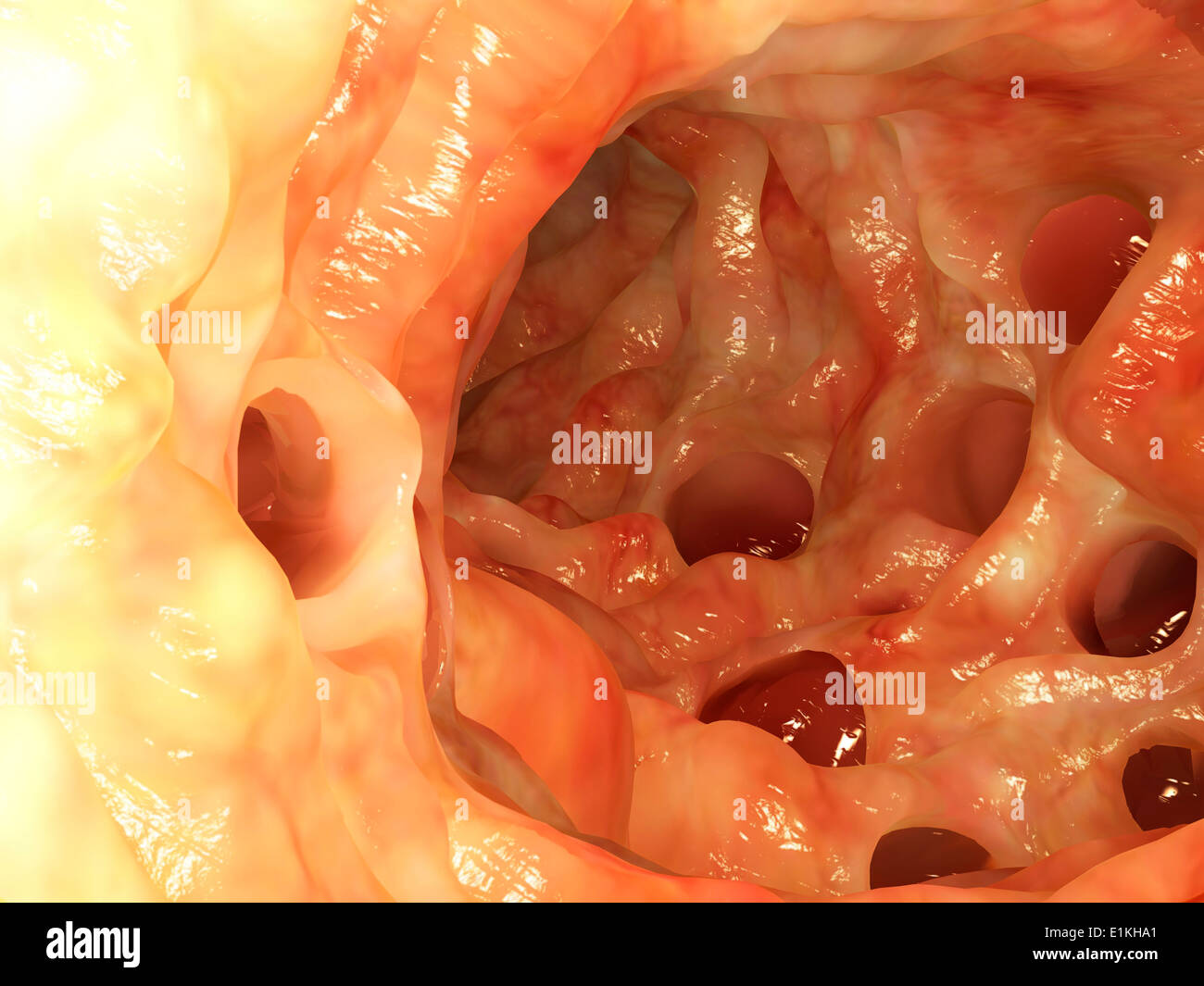 Opera sulla base di un'immagine endoscopica dei diverticoli nel colon. Foto Stock