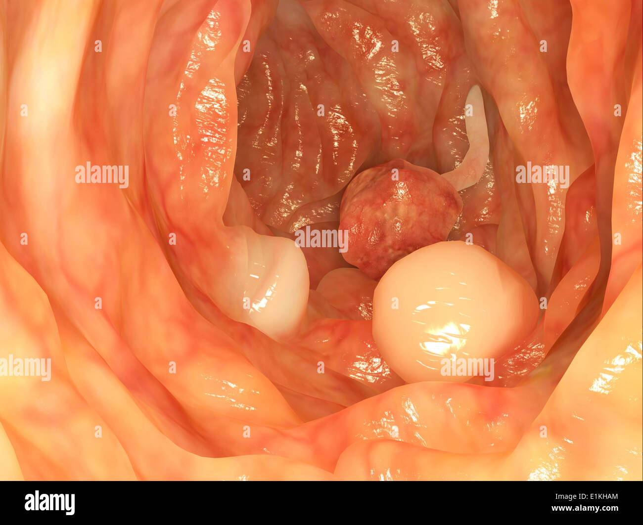 Opera sulla base di un'immagine endoscopica di polipi nel colon. Foto Stock