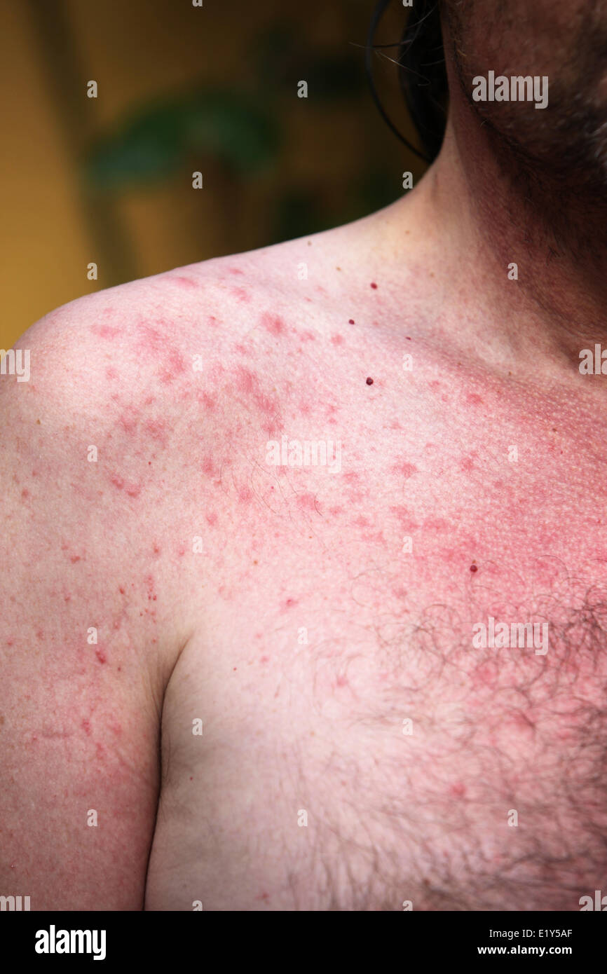 Eruzione cutanea o allergie di Sun Foto Stock