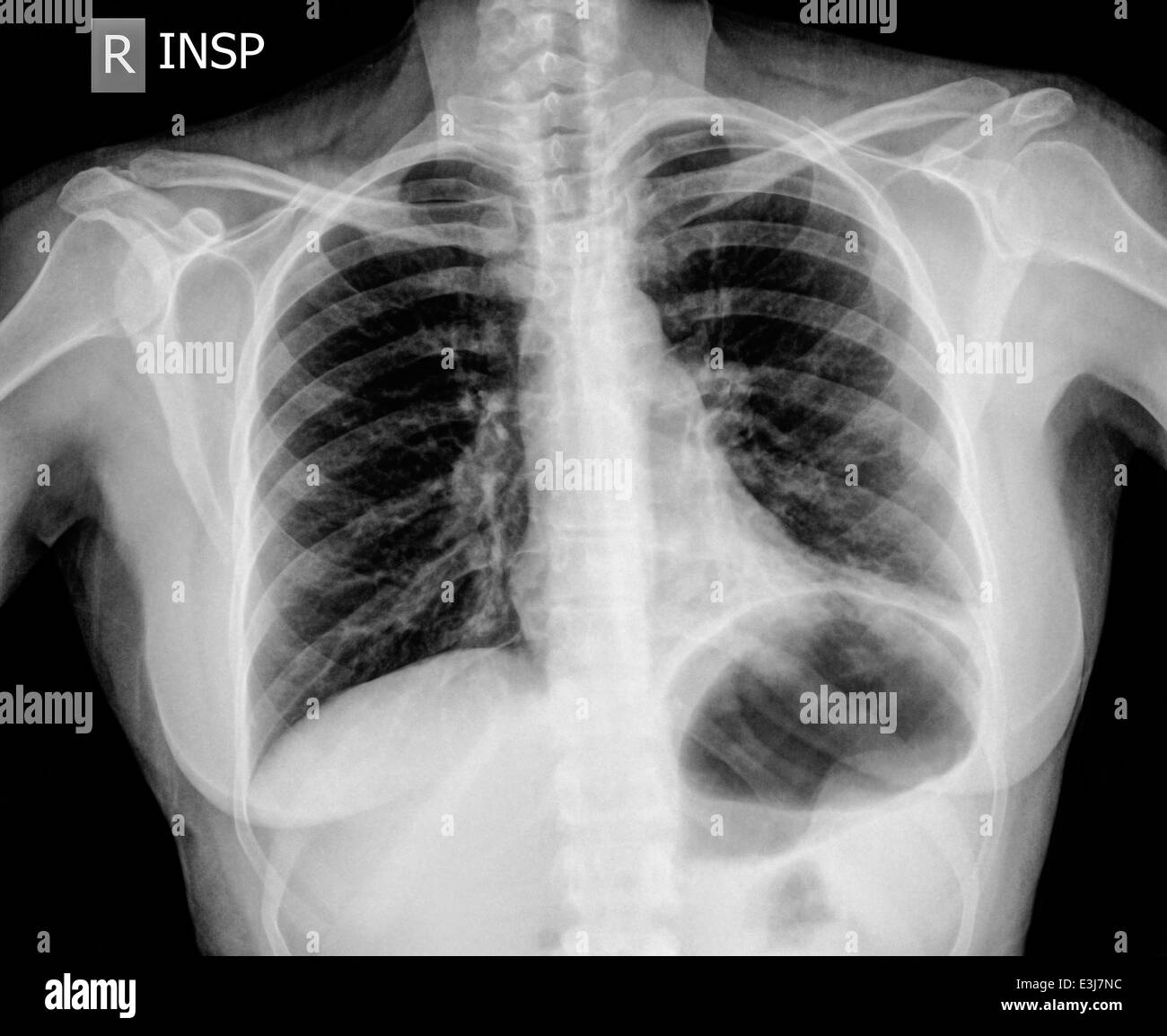 I raggi x al torace di 30 anno vecchio paziente femmina con segni di polmonite in basso a sinistra il lobo (LLL) del suo polmone vista anteriore Foto Stock