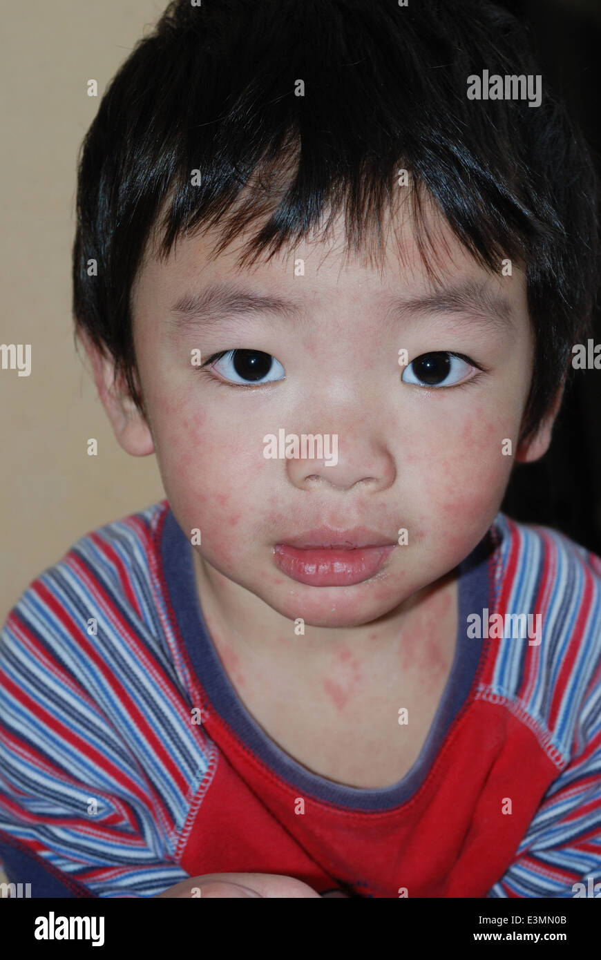 Bambino con mealses eruzioni cutanee su viso e corpo Foto Stock