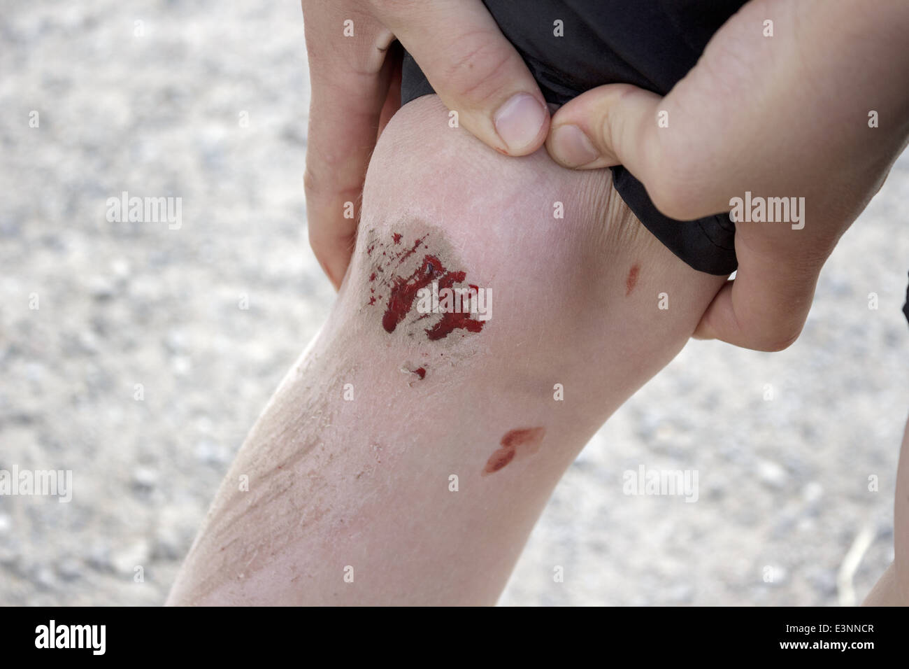 Bambino ginocchio ferito Foto Stock
