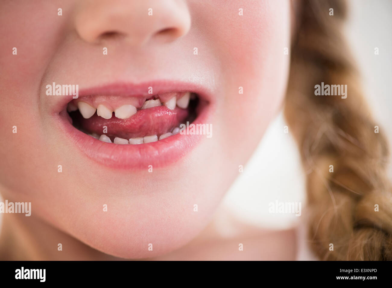 Ragazza caucasica spostando il dente allentato Foto Stock