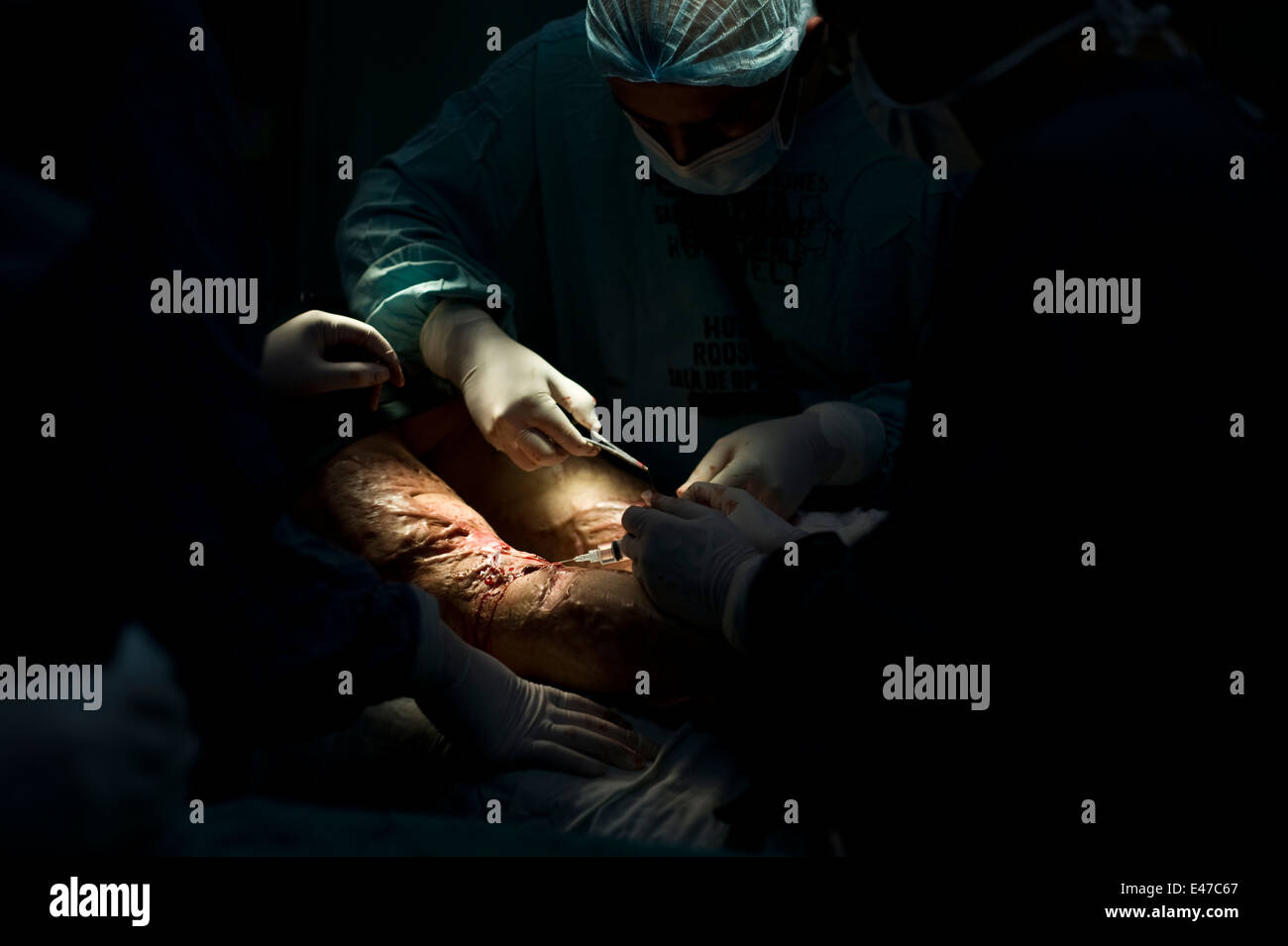 Un innesto di pelle chirurgia per ulcera fulminato sul paziente in ospedale di Roosevelt a Città del Guatemala. Foto Stock