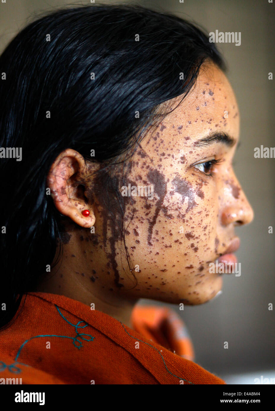 Kustia, Bangladesh. 7 Luglio, 2014. Un 18-anno-vecchia ragazza Sonia Akter soffre di attacchi di acido generata durante il sonno in kustia,Bangladesh ed ha ammesso DMCH. Lancio di acido è un problema comune in Bangladesh. Circa 300 persone attaccare ogni anno in Bangladesh. Il 41 per cento delle vittime sono sotto l'età di 18. Per la maggior parte delle vittime sono 10-30 gruppi di età. 78 acido di percento gettando sta accadendo con le donne. Credito: zakir hossain chowdhury zakir/Alamy Live News Foto Stock