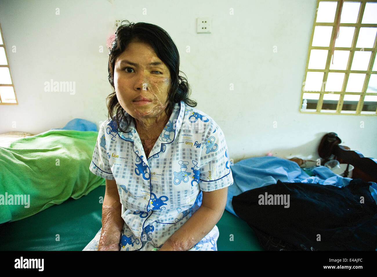 Acido superstite di violenza in Cambogia. Foto Stock