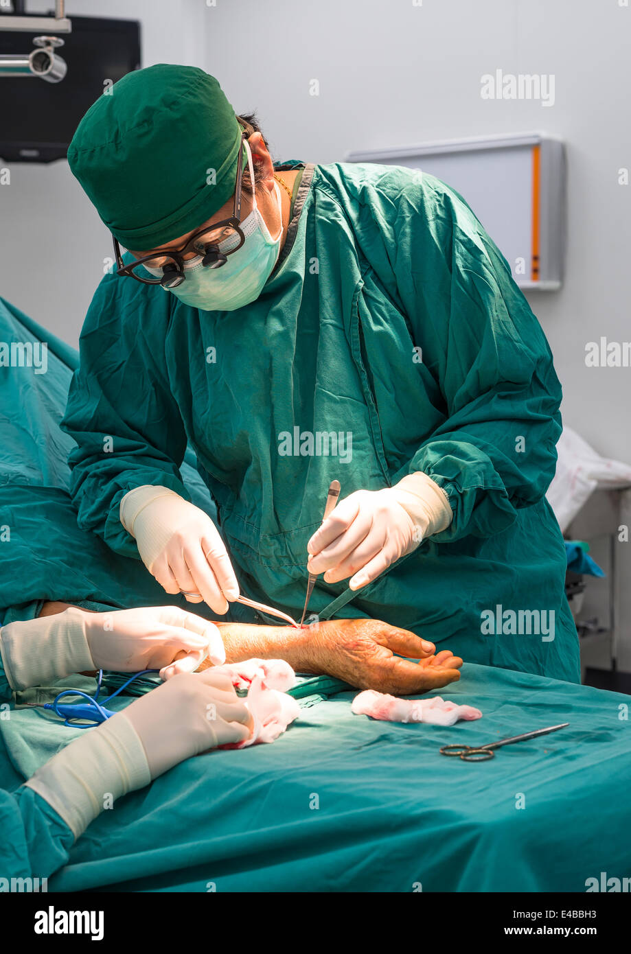 Chirurgo azionando la fistola arterovenosa per lungo termine la dialisi per la malattia renale allo stadio terminale, paziente Foto Stock