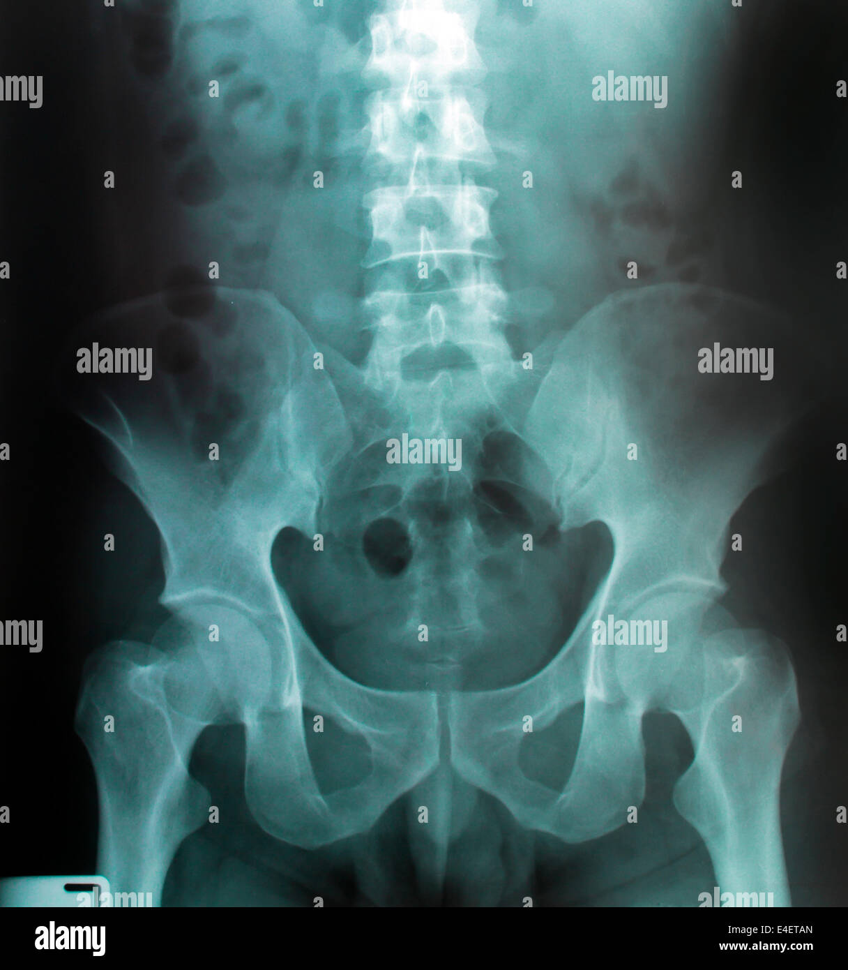 Immagine a raggi X di umana per una diagnosi medica Foto Stock
