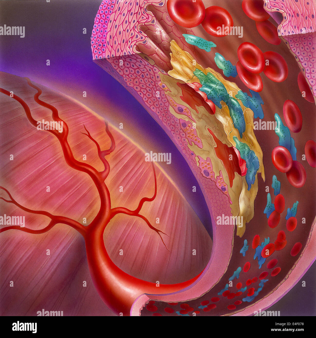 Close-up di arteria che mostra la placca aterosclerotica, piastrine e cellule di sangue rosse. Foto Stock