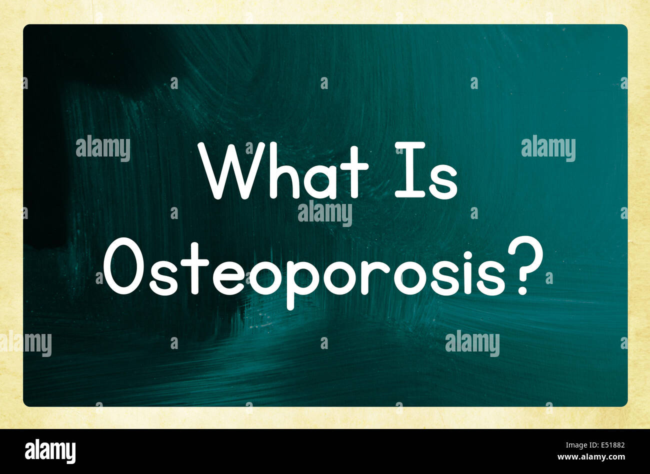 Che cosa è l'osteoporosi? Foto Stock