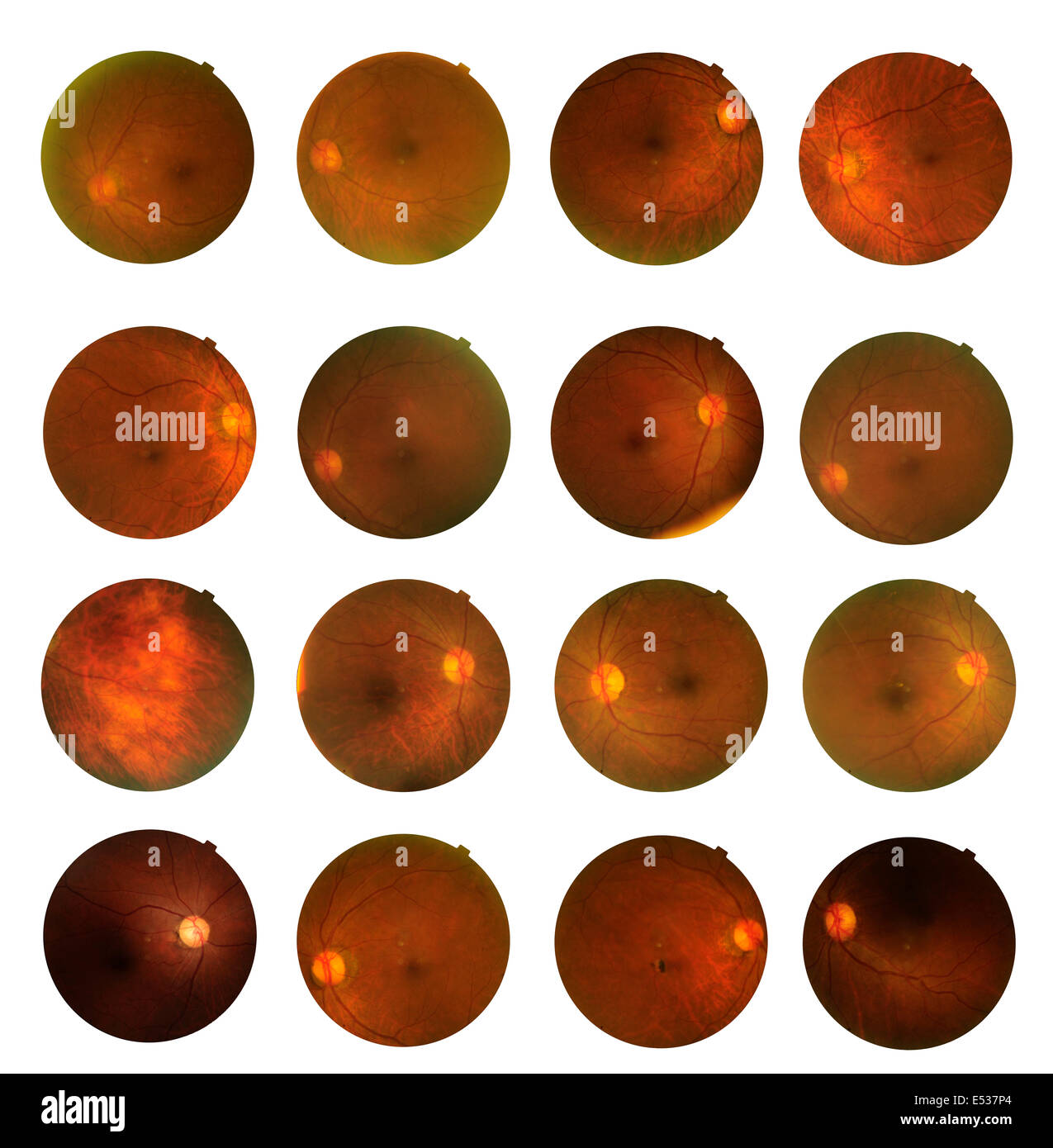 Vista interna occhio umano disordini - Mostra della retina, del nervo ottico e la macula . Foto Stock
