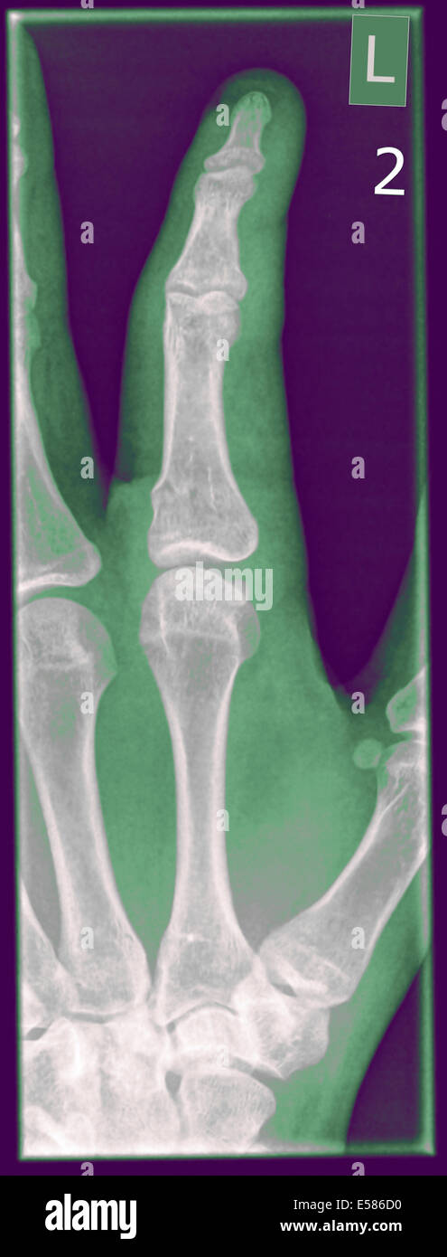 X-ray del dito indice vi è una frattura della falange prossimale osso di quindici anni di paziente di sesso maschile Foto Stock