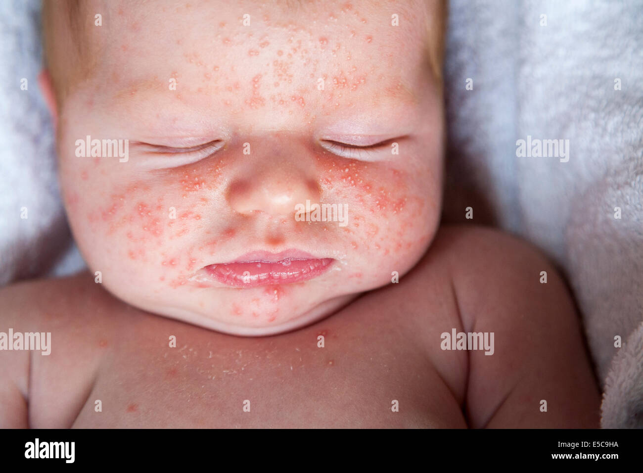 Due settimane vecchio con - probabilmente - baby neonatale acne o ' eritema  Toxicum Neonatorum ' ETN; arriva presto dopo la nascita in molti casi Foto  stock - Alamy