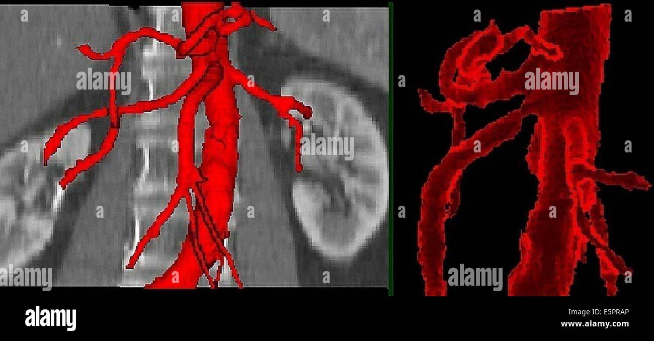3D tomografica computerizzata (CT) la ricostruzione della scansione di una stenosi dell'arteria mesenterica superiore. Foto Stock