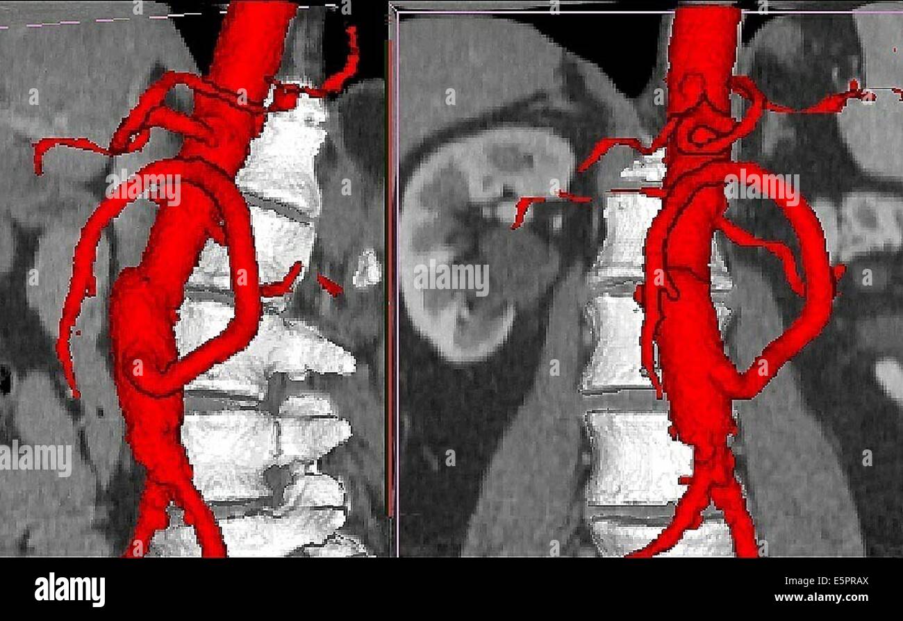 3D tomografica computerizzata (CT) la ricostruzione della scansione di superior aorto-bypass mesenterica. Foto Stock