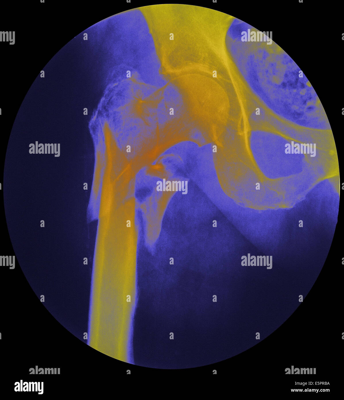 Colorato X-ray del fianco destro di un paziente, che mostra una frattura del collo del femore (giallo). Foto Stock