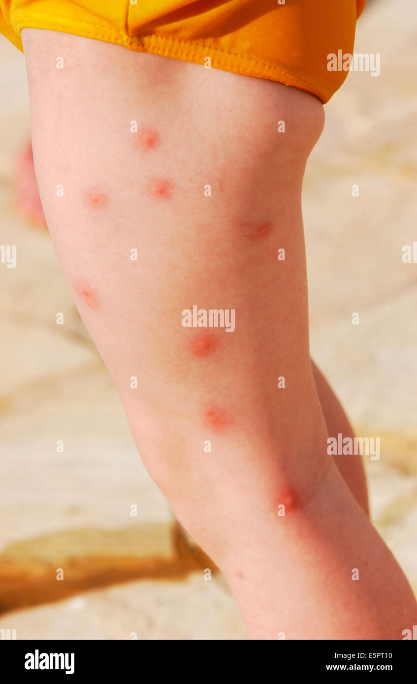 Allergia della pelle causate da punture di zanzara Foto stock - Alamy
