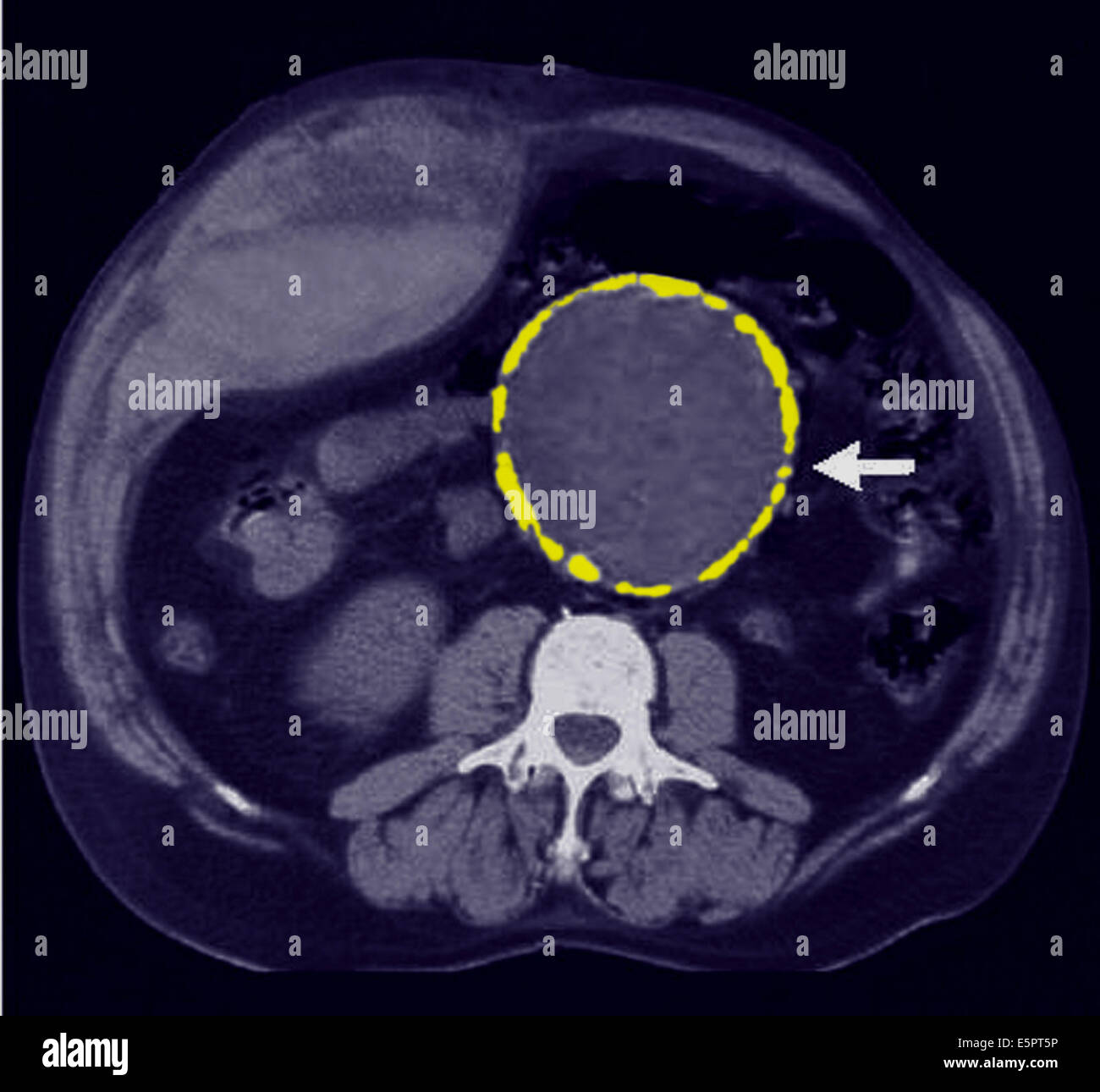 Colorate assiale Tomografia computerizzata (CT) scansione di un aneurisma aortico addominale. La faccia del corpo è verso il basso, Spinebone è Foto Stock