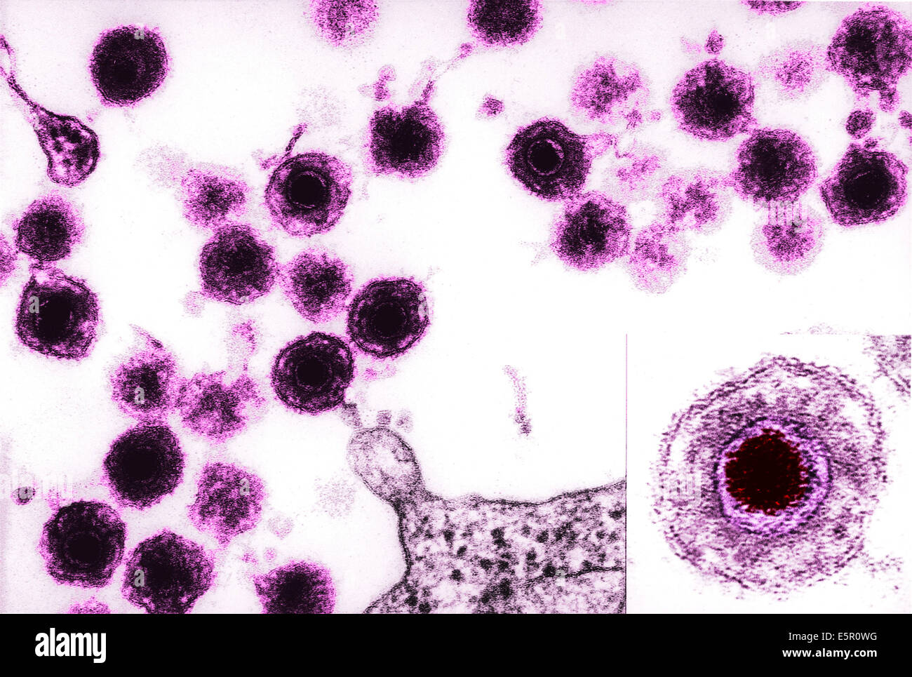 Microscopio elettronico a trasmissione (TEM) di virus di herpes umano 6 (HHV-6) precedentemente chiamato HBLV umano (b-lymphotropic virus), Foto Stock