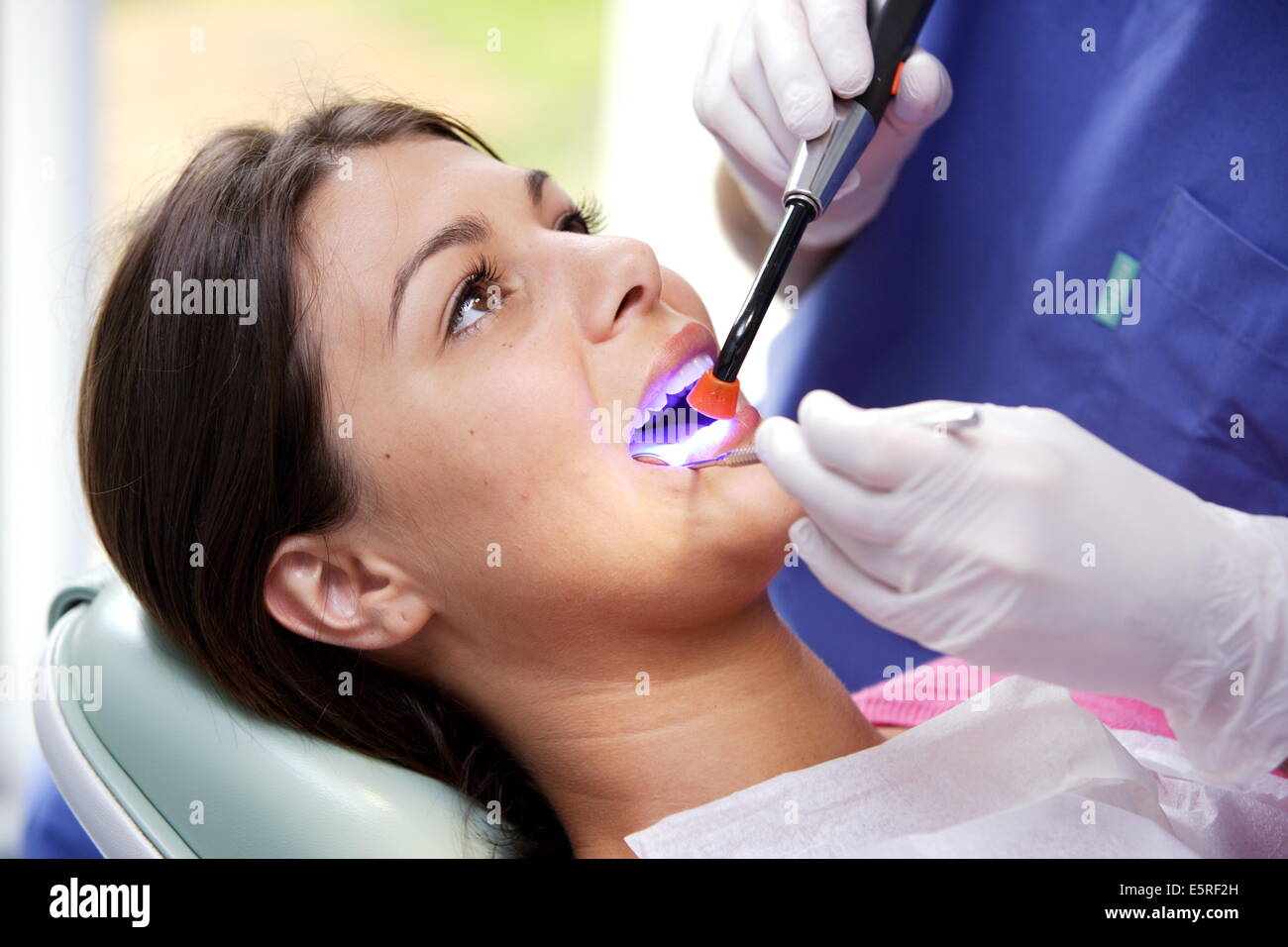 Dentista usando luce ultravioletta per impostare un amalgama fotosensibile (riempimento). Foto Stock