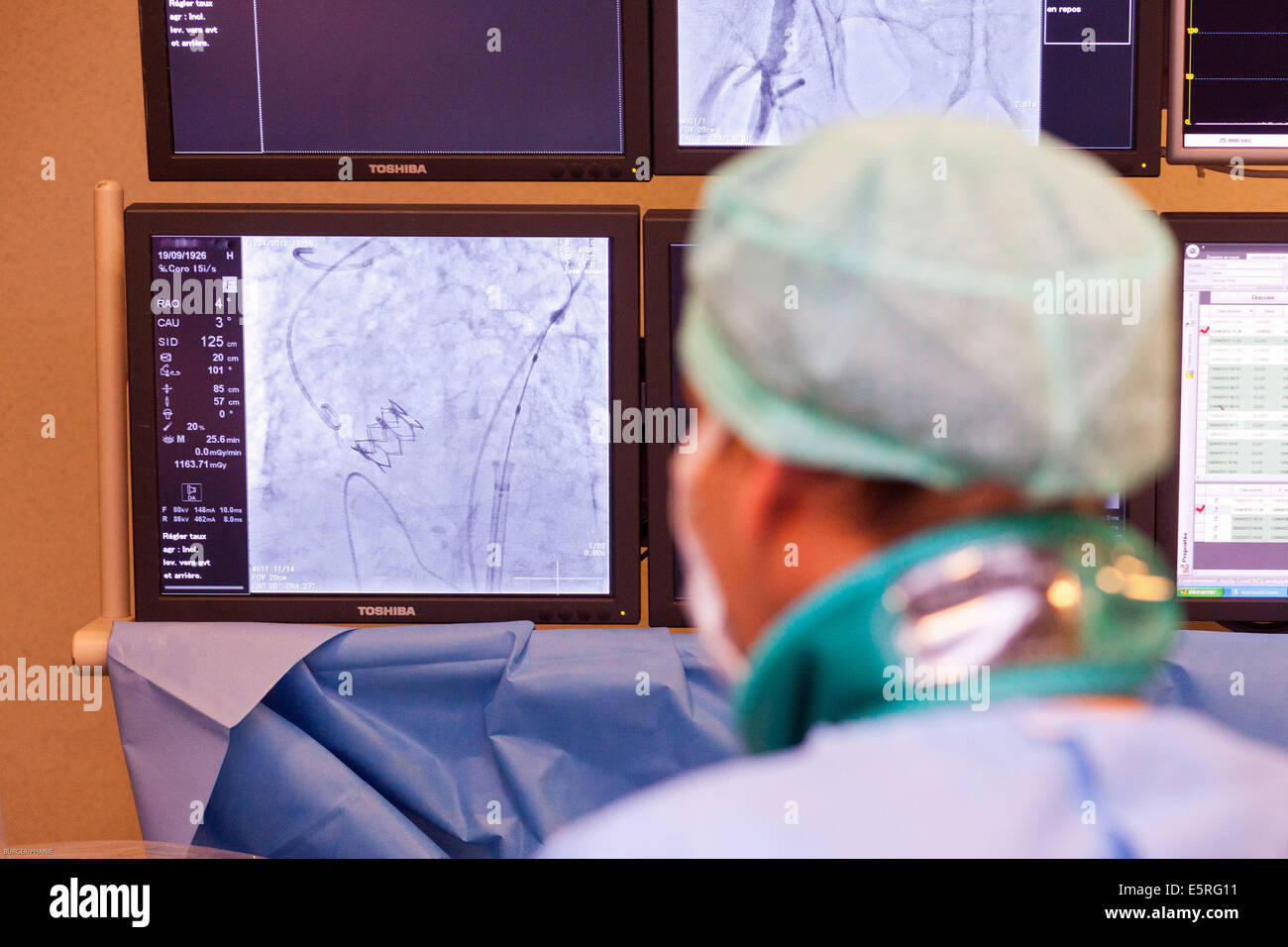 Sostituzione di un percutanea di valvola aortica con una valvola bioprotesica impiantata da transcutanea di sangue, la valvola è inserita Foto Stock
