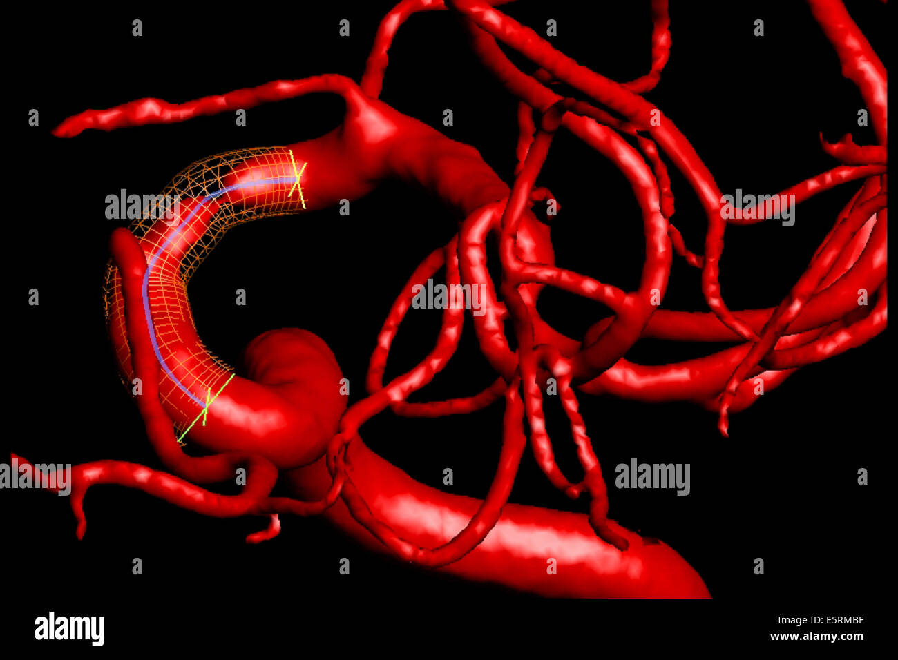 Trattamento delle stenosi carotidee da angioplastica e impostazione di stent protesi, qui, ricostruzione 3D stent virtuale per scegliere la Foto Stock