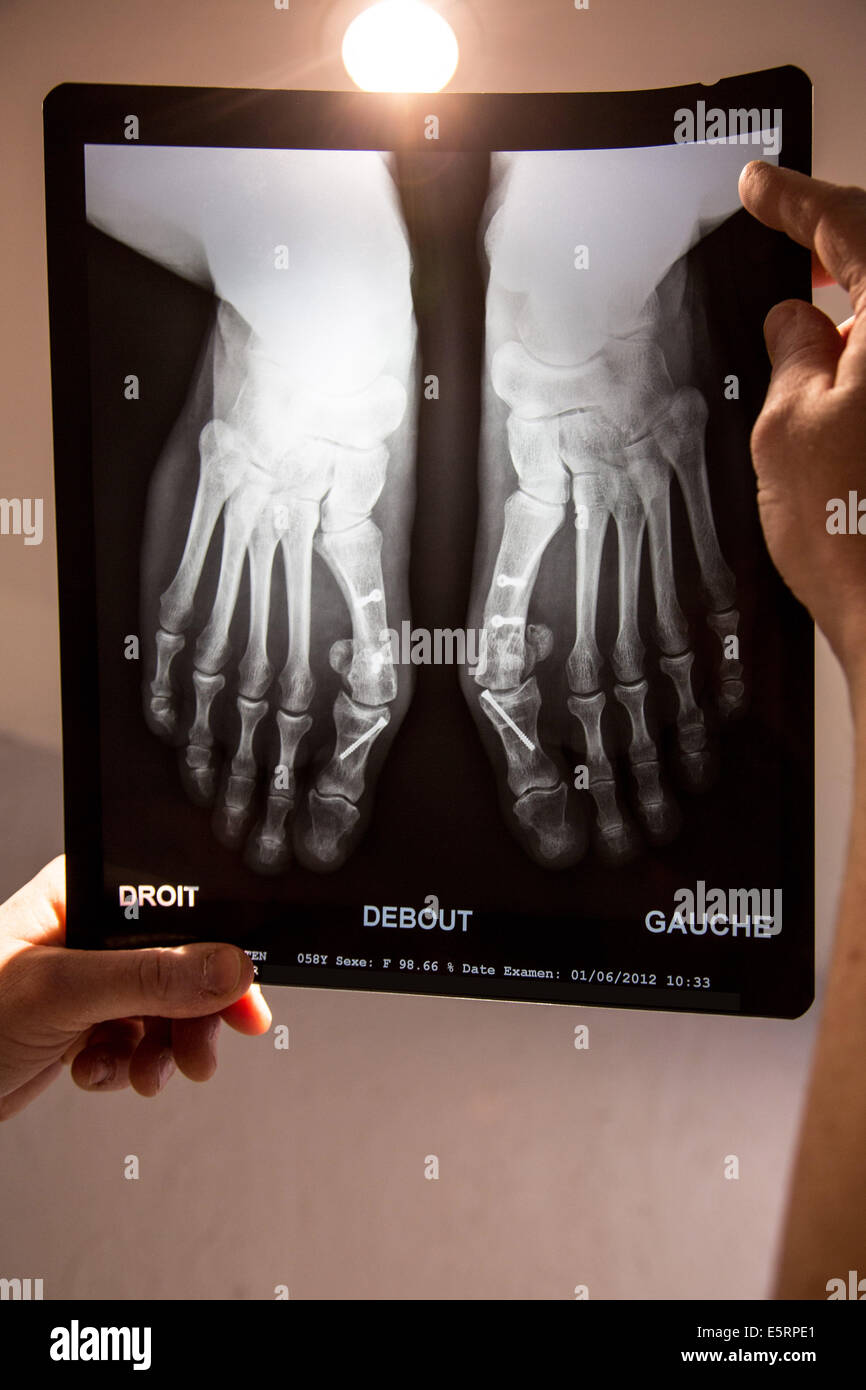 X-ray di piedi colpiti da bunion (alluce valgo) dopo il trattamento chirurgico. Foto Stock
