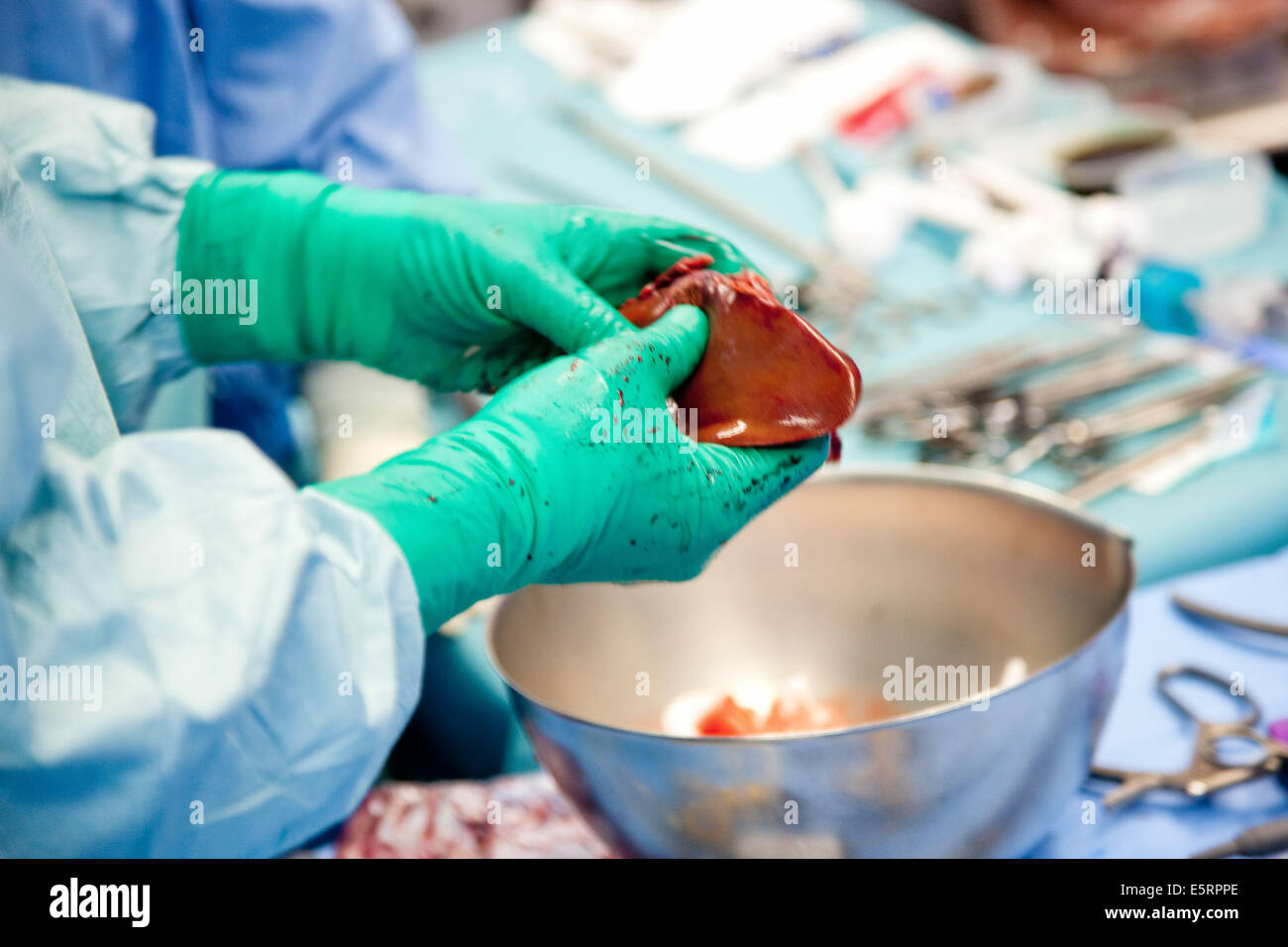 Rimozione parziale di un fegato da un donatore vivente per laparoscopia per un trapianto, qui, preparazione di innesto, Dipartimento di Foto Stock