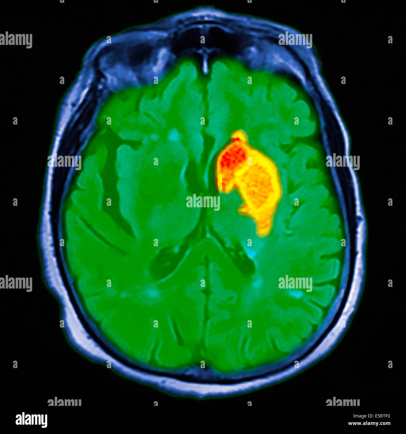 Colorato di risonanza magnetica (RM) e scansione CT di una sezione assiale attraverso il cervello del paziente, che mostra i danni Foto Stock