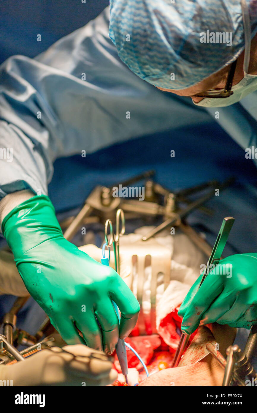 Cistectomia, la rimozione di un cancro della vescica, Diaconesses ospedale, Paris, Francia. Foto Stock
