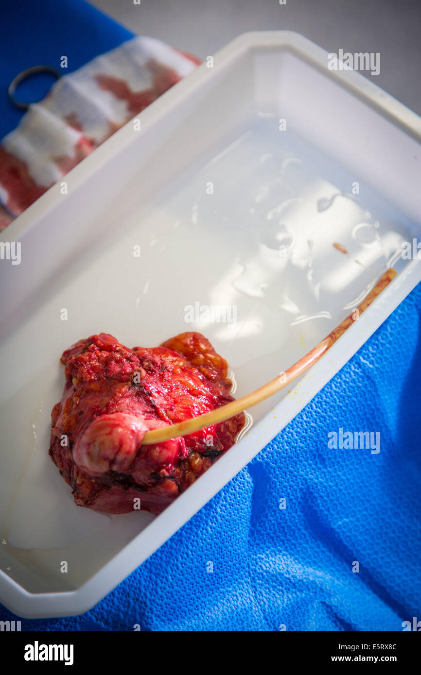 Cistectomia, la rimozione di un cancro della vescica. Foto Stock