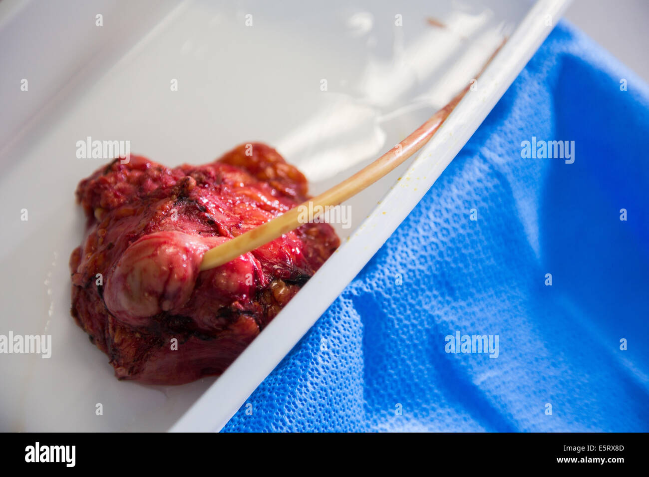 Cistectomia, la rimozione di un cancro della vescica. Foto Stock