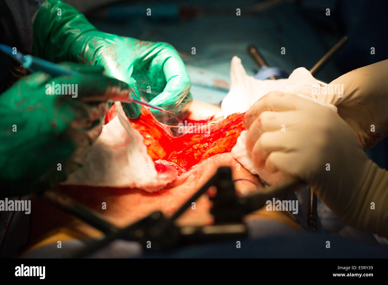 Il trattamento chirurgico di un cancro della vescica mediante cistectomia, ricostruzione della vescica facendo una neo-camera formata con un segmento di Foto Stock