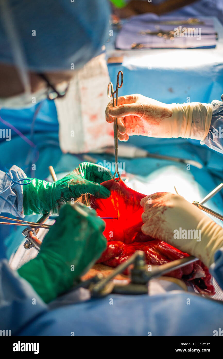 Il trattamento chirurgico di un cancro della vescica mediante cistectomia, ricostruzione della vescica facendo una neo-camera formata con un segmento di Foto Stock