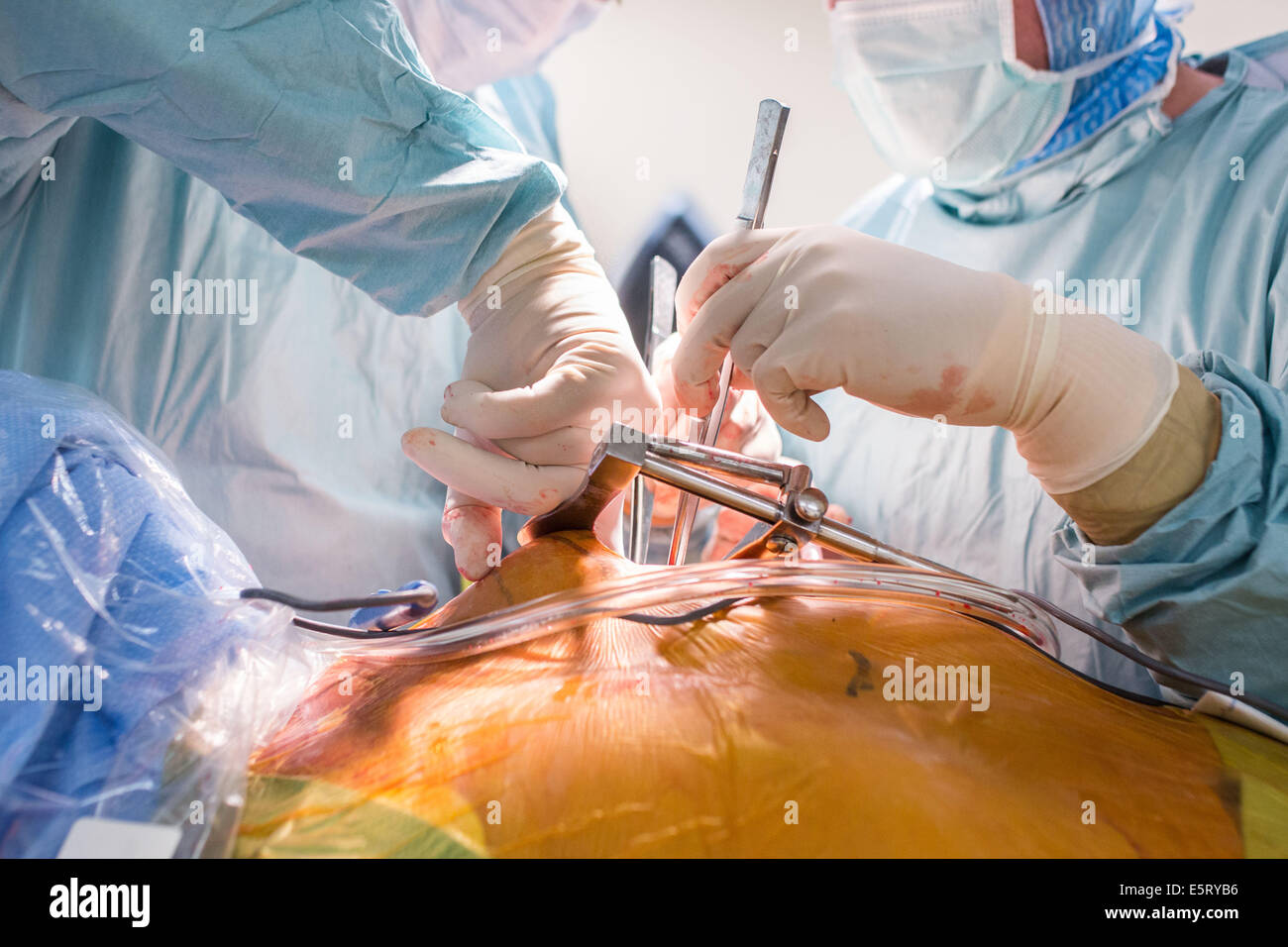 Da Vinci® assistite robotico della chirurgia cardiaca, doppia aortico bypass coronarico con Da Vinci ® robot chirurgico. Ospedale di Limoges, Foto Stock