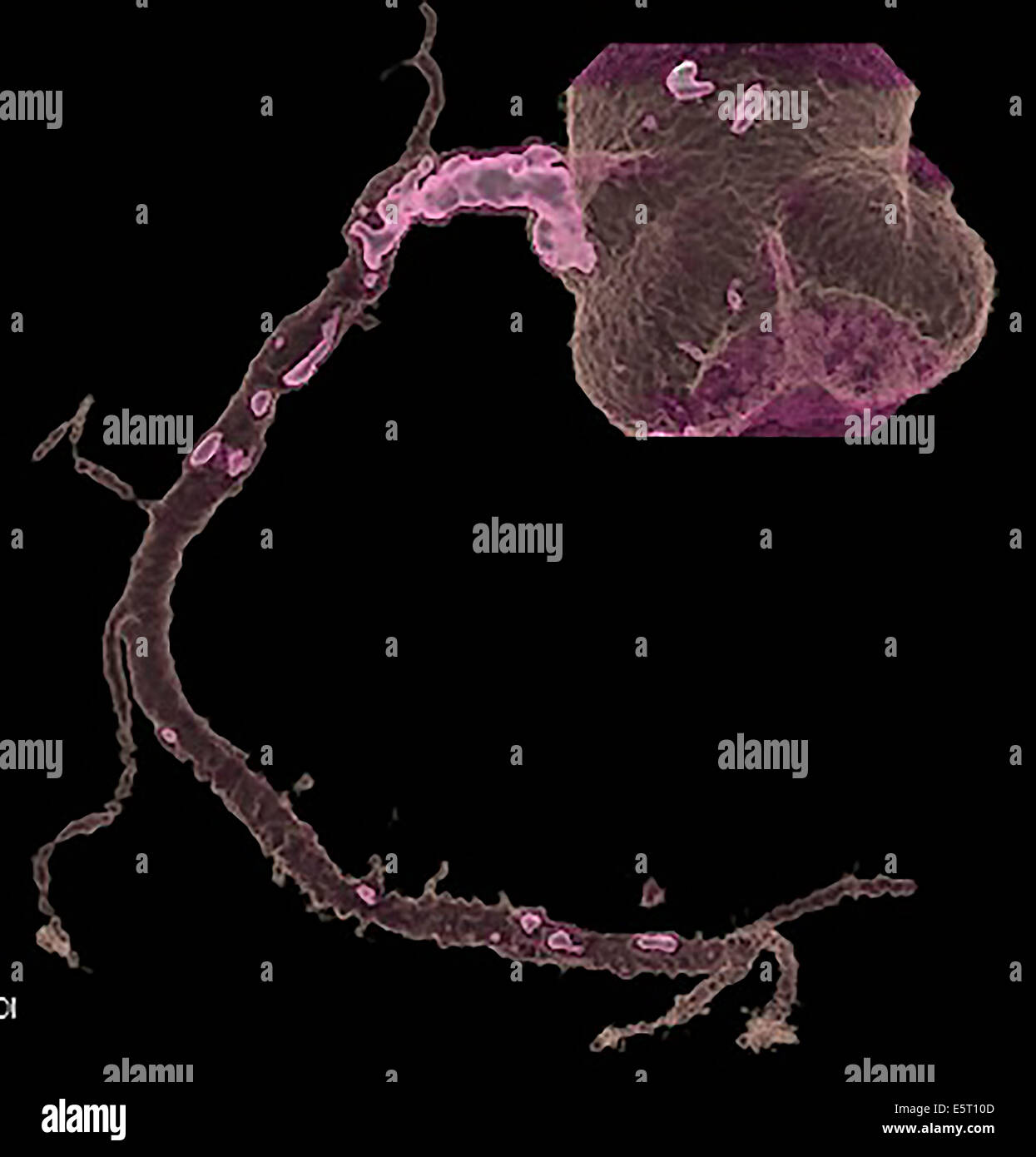 3 colorato-D tomografia computerizzata (CT) Scansione del cuore che mostra una stenosi di una arteria coronaria ristretta di arteriosclerotico Foto Stock