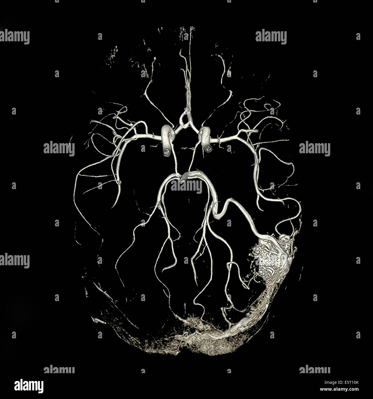 Cerebrale malformazione arterovenosa (AVM) nel lobo occipitale (in basso a destra), 3D CT-angiografia. Foto Stock