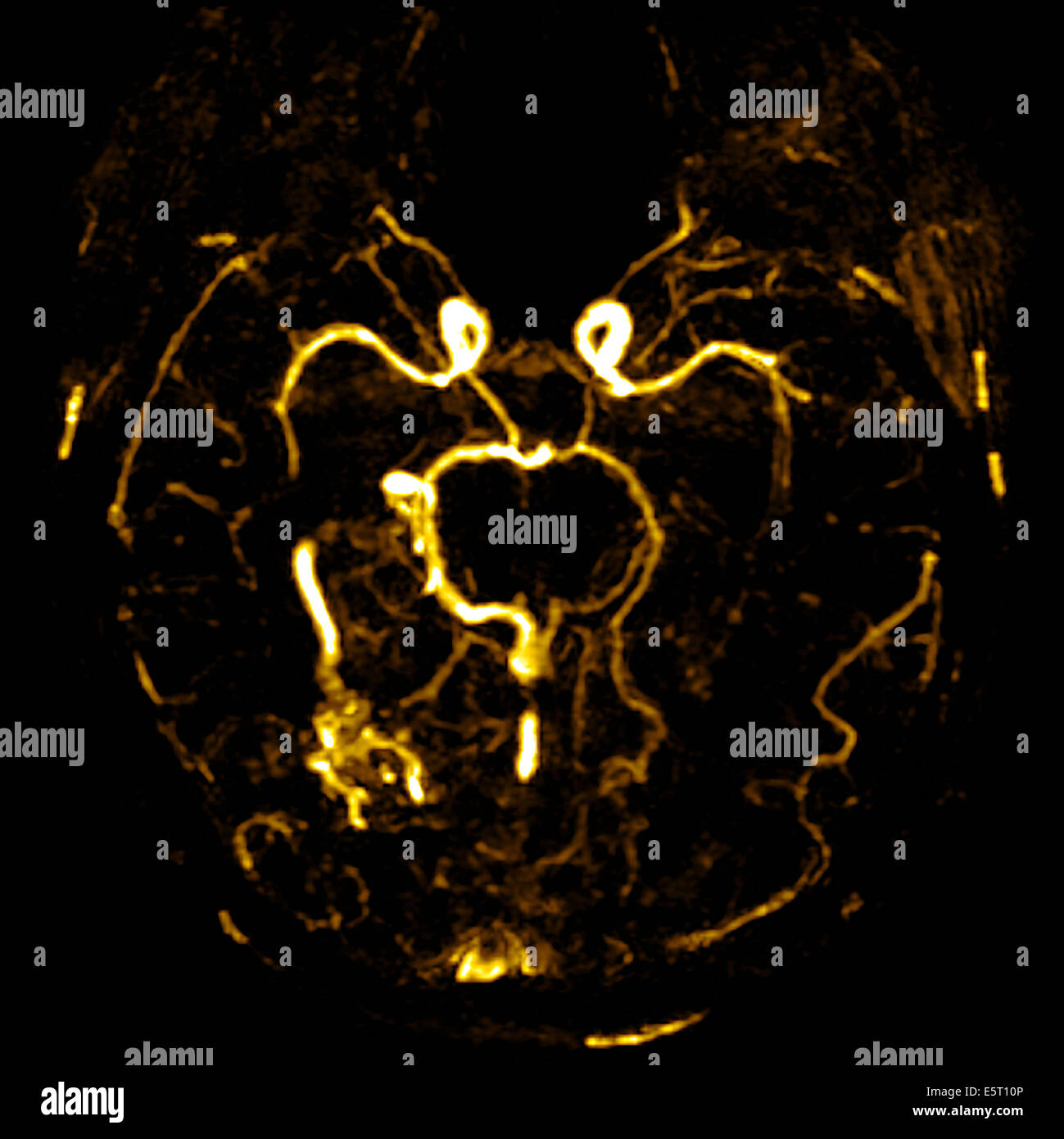 Cerebrale malformazione arterovenosa (AVM) nel lobo occipitale (in basso a sinistra), CT-angiografia. Foto Stock