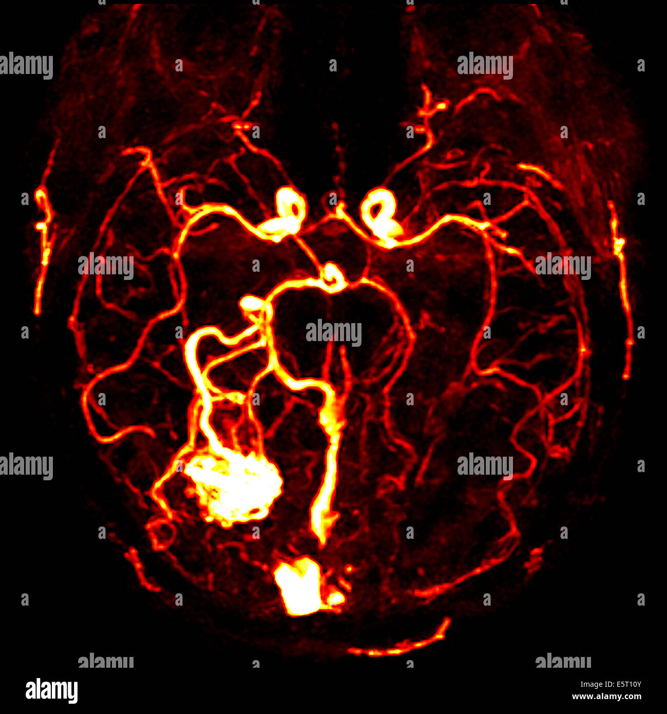 Cerebrale malformazione arterovenosa (AVM) nel lobo occipitale (in basso a sinistra), CT-angiografia. Foto Stock