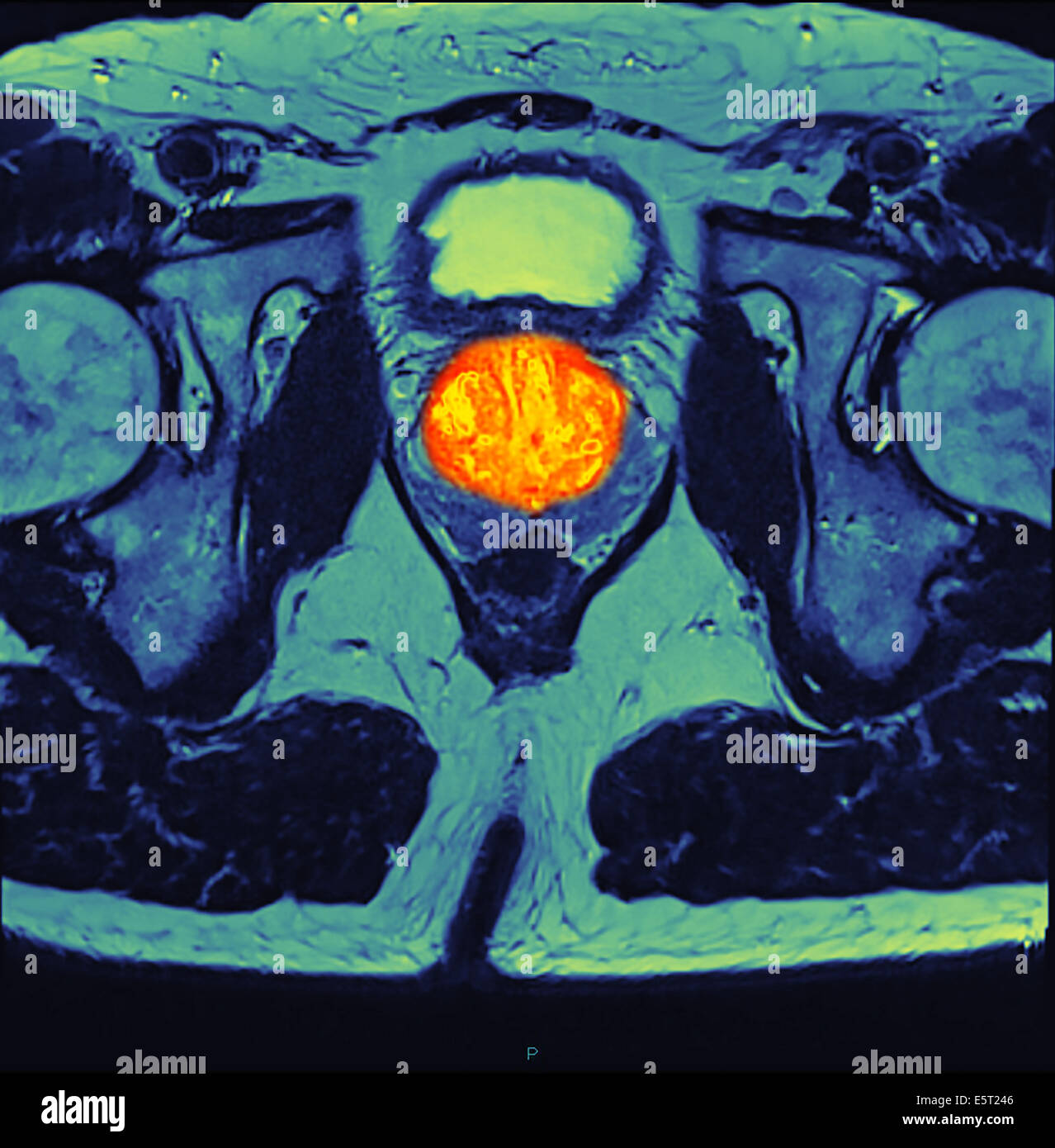 Imaging a risonanza magnetica (MRI) scansione di una sezione attraverso il bacino di un con il cancro della prostata (arancione, al centro). Foto Stock