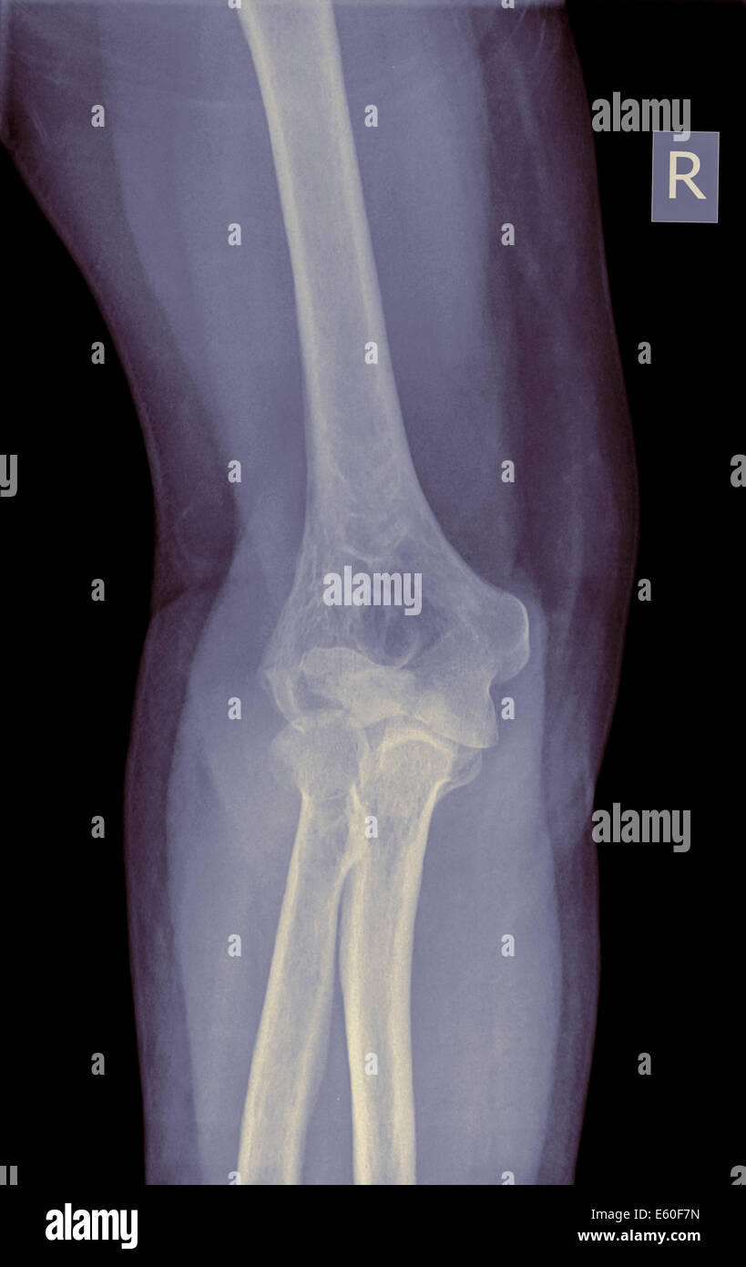 X ray di un gomito fratturato (osso dell'omero) di un vecchio di 70 anni paziente femmina vista frontale Foto Stock
